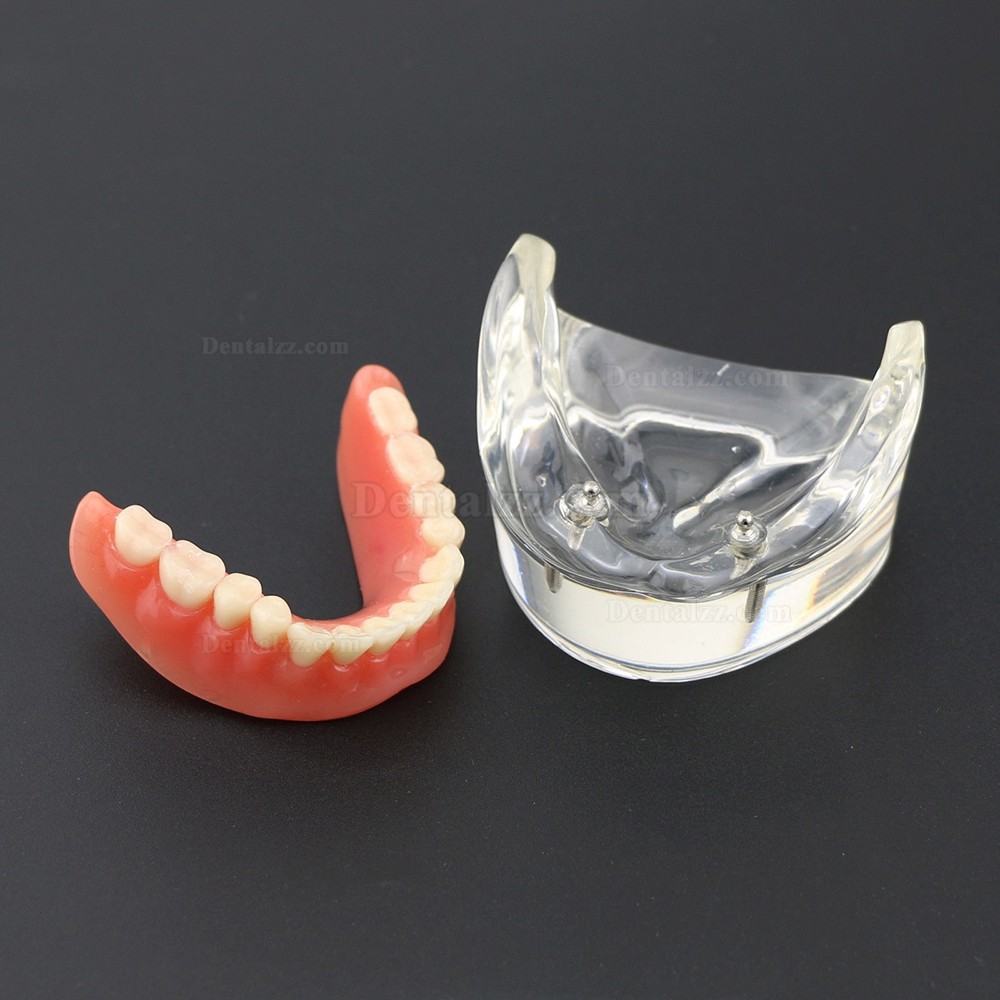 歯科下顎重塁教学用義歯モデル模型 2本インプラント6002 01